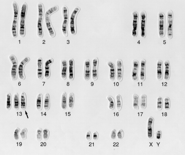 13 хромосома
