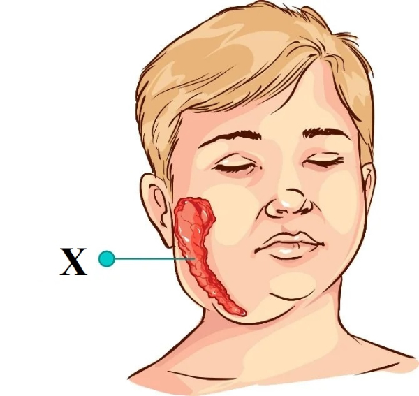 Parotitis adalah gangguan sistem pencernaan yang disebabkan ….